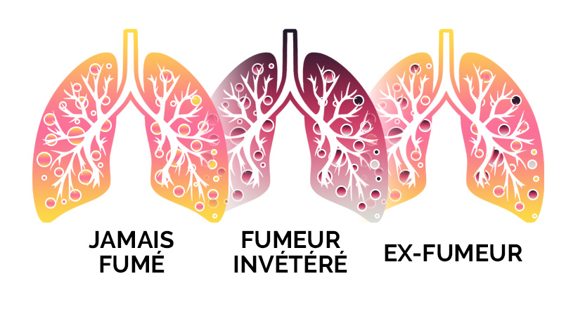 Comment les poumons réagissent ils à l'arrêt de la cigarette ? — A&L